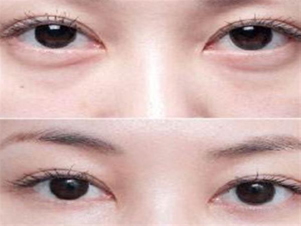 眼袋大怎么回事可以治療嗎