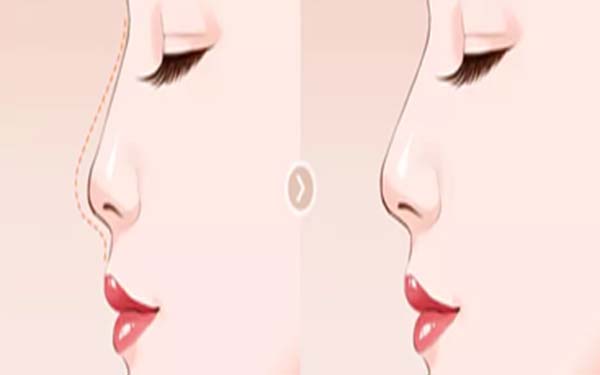 軟肋骨<a href=http://www.bolangguoji.com/listinfo-737-0.html target=_blank class=infotextkey>隆鼻</a>