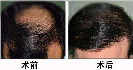   無痕頭發種植的價格