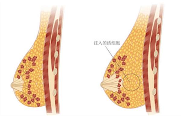 復(fù)合<a href=http://www.bolangguoji.com/listinfo-618-0.html target=_blank class=infotextkey>隆胸</a>的好處