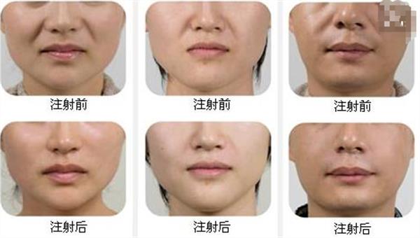 假體墊下巴恢復(fù)過程圖