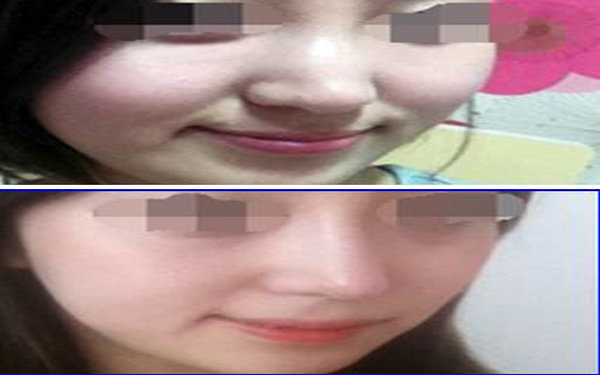 膨體<a href=http://www.bolangguoji.com/listinfo-737-0.html target=_blank class=infotextkey>隆鼻</a>一般幾年取出?
