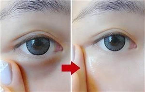 切完眼袋多長時間恢復