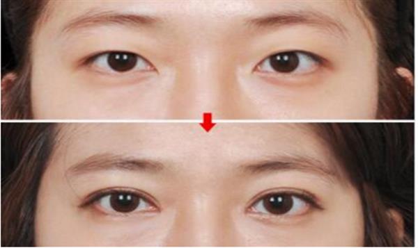 抽脂<a href=http://www.bolangguoji.com/listinfo-708-0.html target=_blank class=infotextkey>去眼袋</a>術后效果怎樣