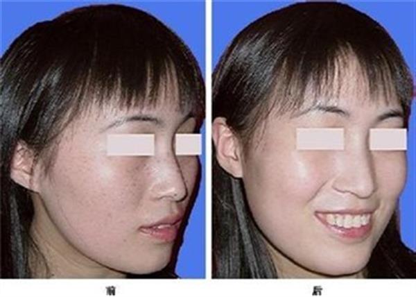 用激光打雀斑多少錢