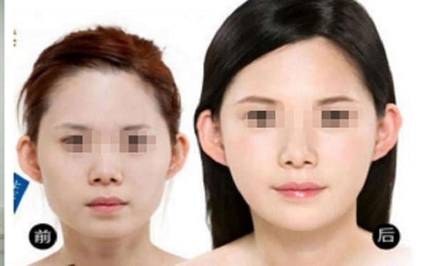 破尿酸<a href=http://www.bolangguoji.com/listinfo-737-0.html target=_blank class=infotextkey>隆鼻</a>后注意事項
