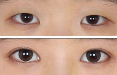 全切<a href=http://www.bolangguoji.com/listinfo-724-0.html target=_blank class=infotextkey>雙眼皮</a>術中過程如何？