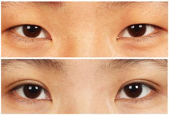 常用的<a href=http://www.bolangguoji.com/listinfo-724-0.html target=_blank class=infotextkey>雙眼皮</a>手術方法有哪幾種