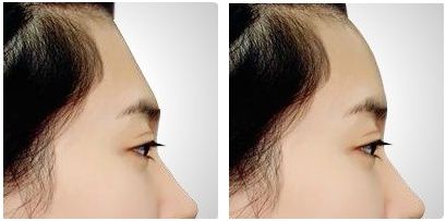自由脂肪<a href=http://www.bolangguoji.com/listinfo-643-0.html target=_blank class=infotextkey>豐額頭</a>多少錢