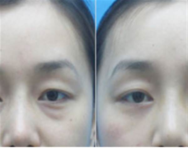 <a href=http://www.bolangguoji.com/listinfo-682-0.html target=_blank class=infotextkey>溶脂</a><a href=http://www.bolangguoji.com/listinfo-708-0.html target=_blank class=infotextkey>去眼袋</a>會不會反彈