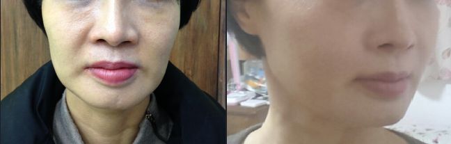 自體脂肪<a href=http://www.bolangguoji.com/listinfo-647-0.html target=_blank class=infotextkey>豐臉頰</a>多少錢