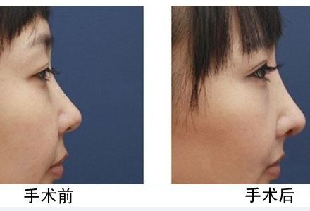 <a href=http://www.bolangguoji.com/listinfo-737-0.html target=_blank class=infotextkey>隆鼻</a>哪種較安全