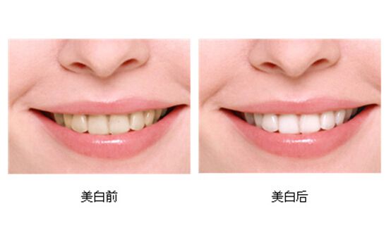 牙貼和冷光美白哪種好