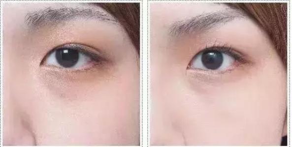 超聲波<a href=http://www.bolangguoji.com/listinfo-708-0.html target=_blank class=infotextkey>去眼袋</a>安全嗎