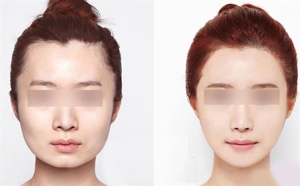 注射<a href=http://www.bolangguoji.com/listinfo-631-0.html target=_blank class=infotextkey>瘦臉</a><a href=http://www.bolangguoji.com/listinfo-614-0.html target=_blank class=infotextkey>除皺</a>后應該注意的事項