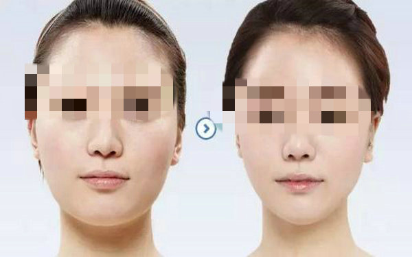 面部激光<a href=http://www.bolangguoji.com/listinfo-682-0.html target=_blank class=infotextkey>溶脂</a>恢復期