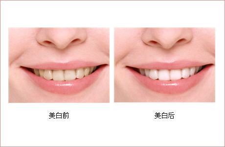 <a href=http://www.bolangguoji.com/listinfo-828-0.html target=_blank class=infotextkey>牙齒美白</a>的辦法有哪些呢