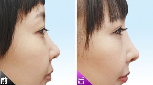 注射<a href=http://www.bolangguoji.com/listinfo-737-0.html target=_blank class=infotextkey>隆鼻</a>價格貴嗎