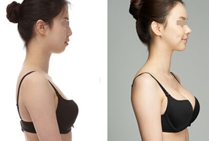  自體健康細胞脂肪<a href=http://www.bolangguoji.com/listinfo-618-0.html target=_blank class=infotextkey>隆胸</a>
