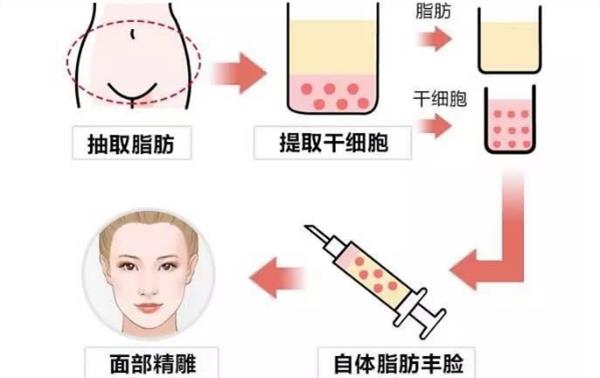脂肪填充疼嗎