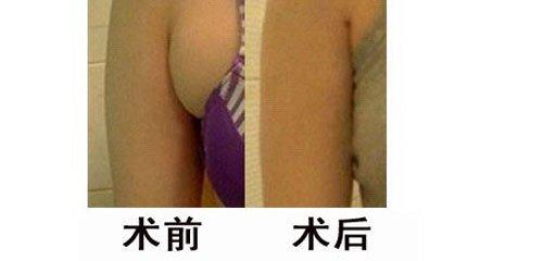 副乳切除手術幾天恢復