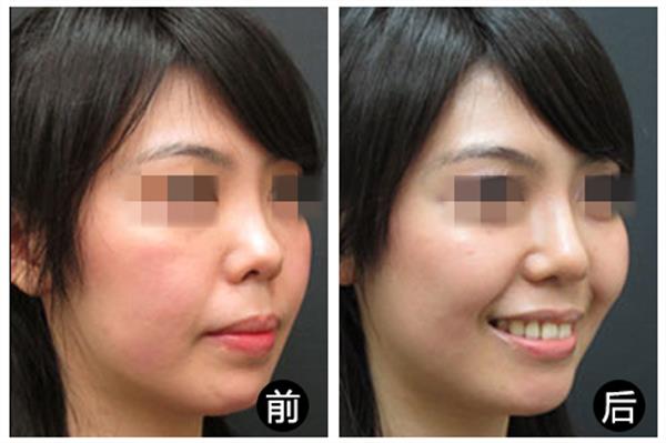 <a href=http://www.bolangguoji.com/listinfo-737-0.html target=_blank class=infotextkey>隆鼻</a>一般價位多少
