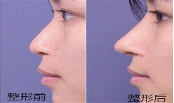 透明質酸<a href=http://www.bolangguoji.com/listinfo-737-0.html target=_blank class=infotextkey>隆鼻</a>后的案例效果圖