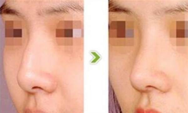 膨體<a href=http://www.bolangguoji.com/listinfo-737-0.html target=_blank class=infotextkey>隆鼻</a>的一些優(yōu)勢