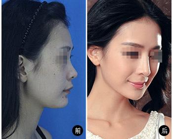 做鼻假體有危險(xiǎn)嗎