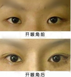 <a href=http://www.bolangguoji.com/listinfo-711-0.html target=_blank class=infotextkey>開眼角</a>手術(shù)修復(fù)哪里好