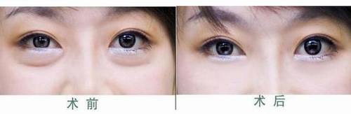 做外切眼袋多久能恢復