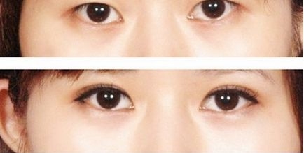 手術(shù)后形成重瞼的樣式有哪些