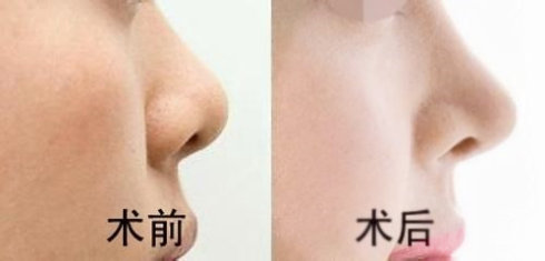 假體<a href=http://www.bolangguoji.com/listinfo-737-0.html target=_blank class=infotextkey>隆鼻</a>醫院哪個好