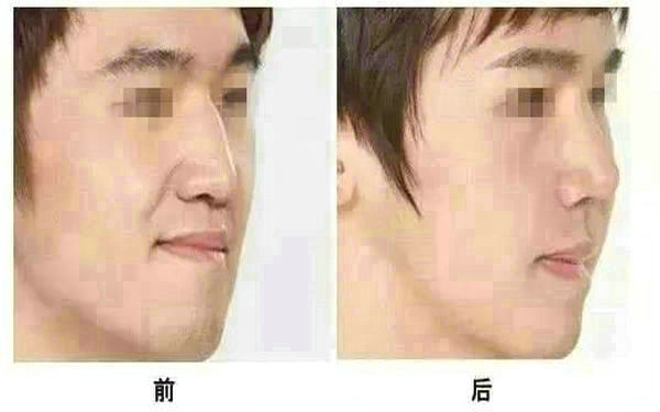 面部光纖<a href=http://www.bolangguoji.com/listinfo-682-0.html target=_blank class=infotextkey>溶脂</a>會反彈嗎?