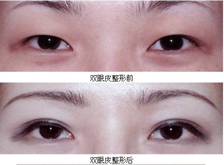 割<a href=http://www.bolangguoji.com/listinfo-724-0.html target=_blank class=infotextkey>雙眼皮</a>抽脂疼嗎