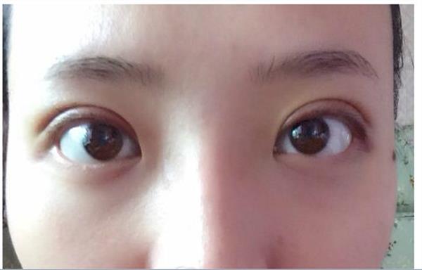 埋線<a href=http://www.bolangguoji.com/listinfo-724-0.html target=_blank class=infotextkey>雙眼皮</a>前列天照片