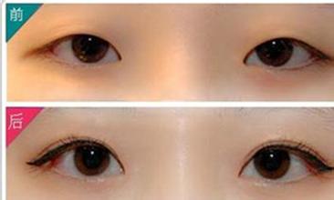 埋線法割<a href=http://www.bolangguoji.com/listinfo-724-0.html target=_blank class=infotextkey>雙眼皮</a>原理