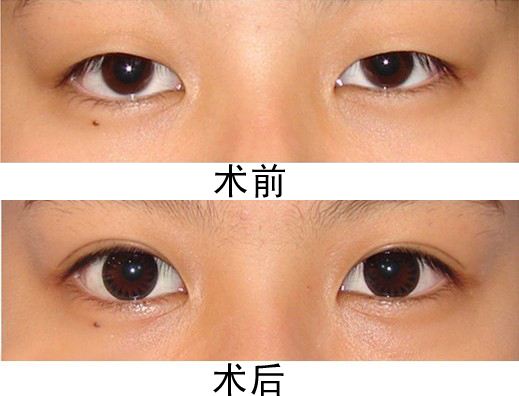 廣州做<a href=http://www.bolangguoji.com/listinfo-724-0.html target=_blank class=infotextkey>雙眼皮</a>多少錢