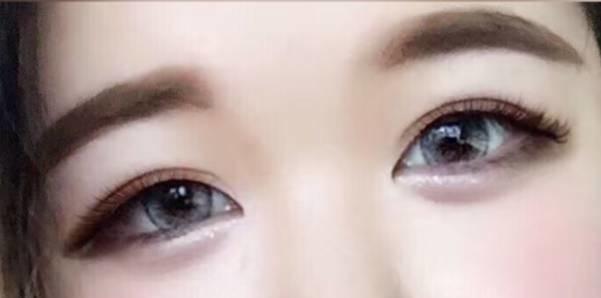 全切<a href=http://www.bolangguoji.com/listinfo-724-0.html target=_blank class=infotextkey>雙眼皮</a>20天還腫如何修復？