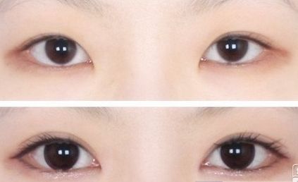 割<a href=http://www.bolangguoji.com/listinfo-724-0.html target=_blank class=infotextkey>雙眼皮</a>后幾天拆線