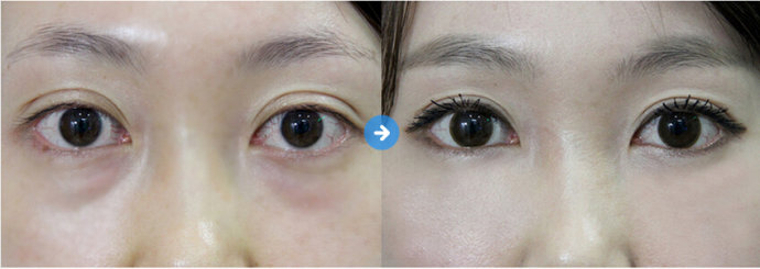 鐳射<a href=http://www.bolangguoji.com/listinfo-708-0.html target=_blank class=infotextkey>去眼袋</a>有風險嗎