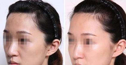 臉部脂肪填充價格