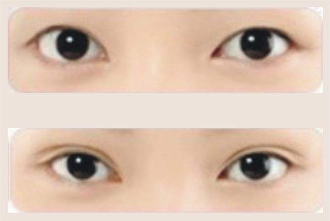 襄陽中心醫(yī)院割<a href=http://www.bolangguoji.com/listinfo-724-0.html target=_blank class=infotextkey>雙眼皮</a>