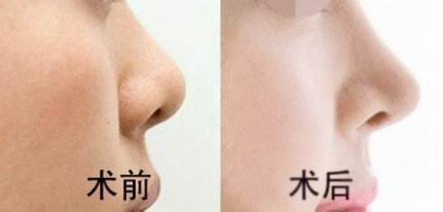<a href=http://www.bolangguoji.com/listinfo-737-0.html target=_blank class=infotextkey>隆鼻</a>多久鼻頭可以消腫