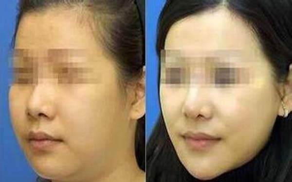 打<a href=http://www.bolangguoji.com/listinfo-631-0.html target=_blank class=infotextkey>瘦臉</a><a href=http://www.bolangguoji.com/listinfo-614-0.html target=_blank class=infotextkey>除皺</a>前后對比圖