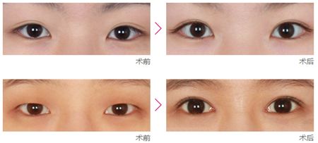 做<a href=http://www.bolangguoji.com/listinfo-711-0.html target=_blank class=infotextkey>開眼角</a>手術完全恢復需要多長時間