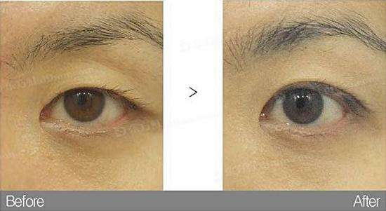 <a href=http://www.bolangguoji.com/listinfo-724-0.html target=_blank class=infotextkey>雙眼皮</a>紫色淤青怎么消