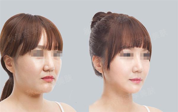 打完<a href=http://www.bolangguoji.com/listinfo-631-0.html target=_blank class=infotextkey>瘦臉</a><a href=http://www.bolangguoji.com/listinfo-614-0.html target=_blank class=infotextkey>除皺</a>多久吃飯