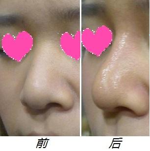 假體<a href=http://www.bolangguoji.com/listinfo-737-0.html target=_blank class=infotextkey>隆鼻</a>恢復(fù)過(guò)程案例
