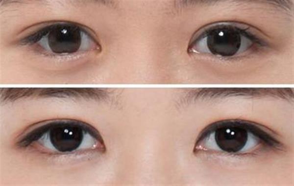 <a href=http://www.bolangguoji.com/listinfo-724-0.html target=_blank class=infotextkey>雙眼皮</a>全切1個月恢復圖效果對比